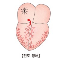 부정맥