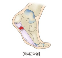 족저 근막염