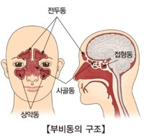 부비동염