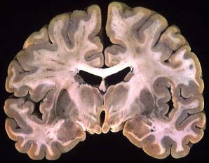 예쁘게 coronal section한 brain