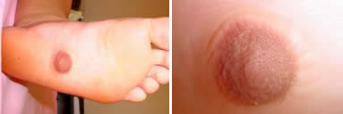 Nipple on Woman's Foot