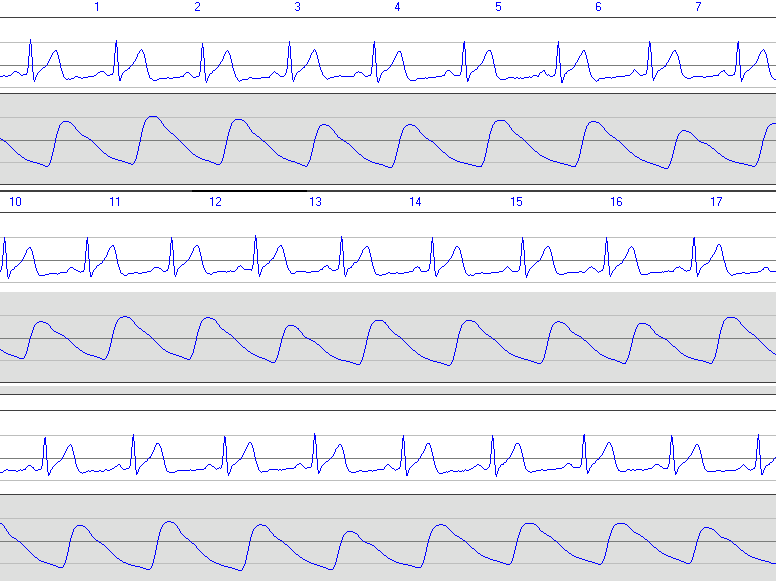 심전도 EKG 그래프