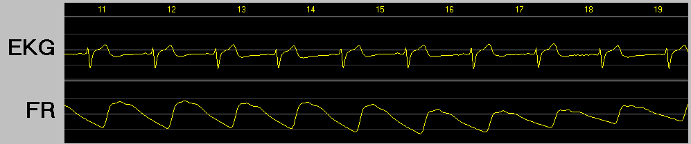 심전도 EKG 그래프